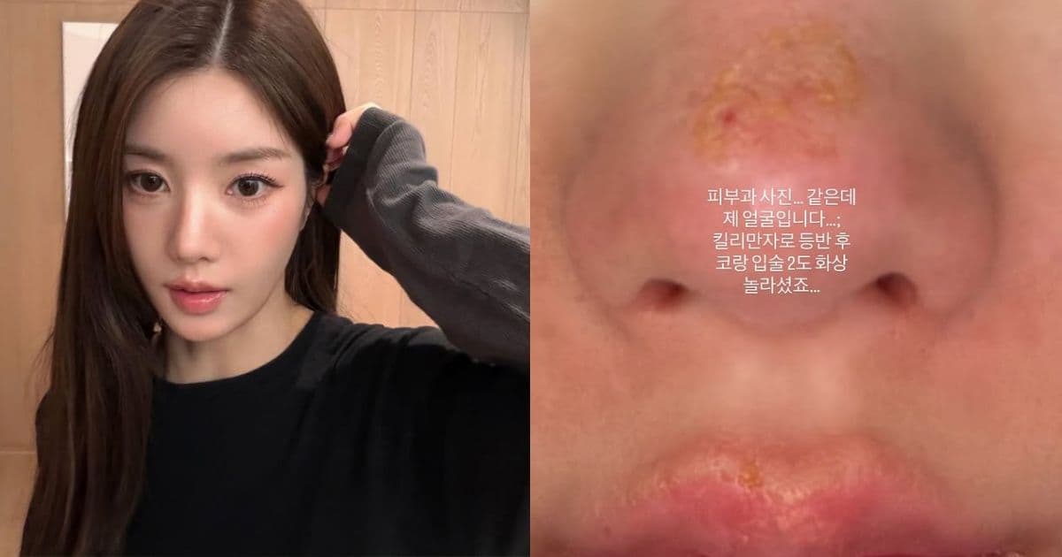 「這真的是我的臉！」 權恩妃突PO鼻、唇二度燙傷近照 粉絲全嚇壞