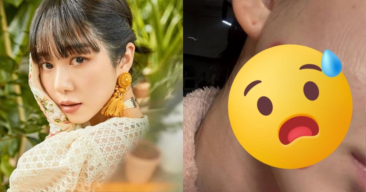 剛輕生被救回！前AOA權珉娥醫美變毀容　臉部二度燒傷痛喊「像皮被撕裂」